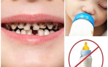 تسوس اسنان الرضيع ،الأسباب وكيفة والوقاية..
