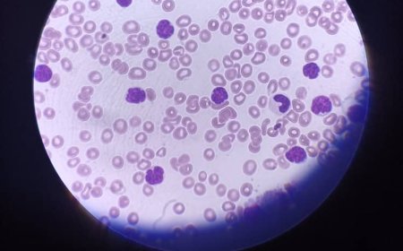 مختبرات "ترست لاب" الطبية بالمهرة تنحج في تشخيص حالة سرطان دم لمريضة