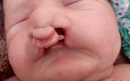 مناشدة عاجلة لإنقاذه :  طفل يبصر النور منذ ساعات بتشوهات خلقية "تمنعه من الرضاعة" بأبين