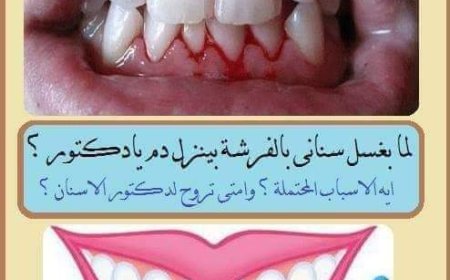ثقافية صحية.. نزيف اللثة أثناء تنظيف الأسنان ..  أسبابه ونصائح لتجنبه