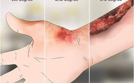 بعض الأخطاء الشائعة في :: حالات الحروق ::