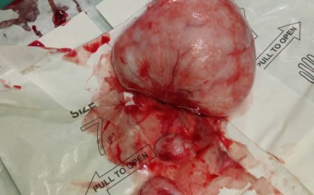 مستشفى زنجبار يجري عملية استئصال ورم ليفي من فتاة تبلغ من العمر 35 عام