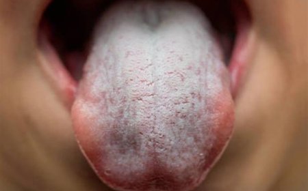 (ثقافةصحية) هل جفاف الفم بعد الحلويات يشير للإصابة بالسكري؟ 