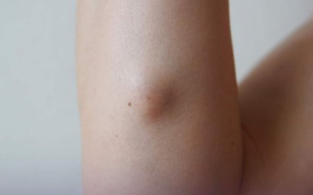 (ثقافة صحية)؛ ما الفرق بين #الكيس_الدهني و #الورم ؟