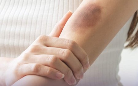 ( ثقافة صحية) كدمات_الجسم !! ..أسبابها وعلاجها