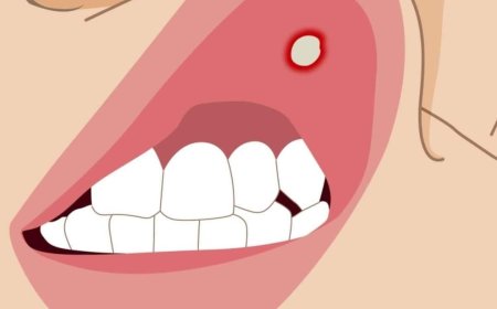 علاج تقرحات الفم واللثة!!