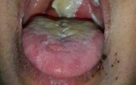 مديرة التثقيف والاعلام الصحي بعدن تدق ناقوس الخطر من انتشار مرض الدفتيريا بين الأطفال 