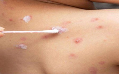 رصد أول إصابة بـ"جدري الماء"في #المهرة