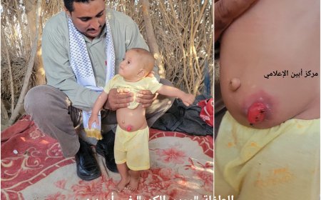 الطفلة "مريم الكور" في أبين : حالة إنسانية مؤثرة تنتظر من ينقذها ..!!