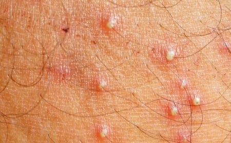 التهاب بصيلات الشعر: مشكلة جلدية شائعة تستحق الانتباه!