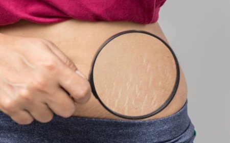 ( ثقافة صحية) هل تعاني من #الخطوط_البيضاء في جسمك؟ إليك الأسباب وطرق العلاج!