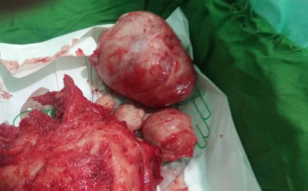 مستشفى زنجبار ينجح في استئصال ورم من امرأة تبلغ العمر 50 عاماً
