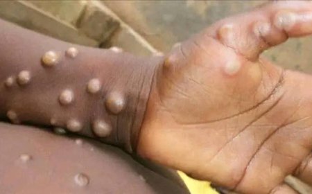 أول أصابة بجذري القرود بمحافظة إب