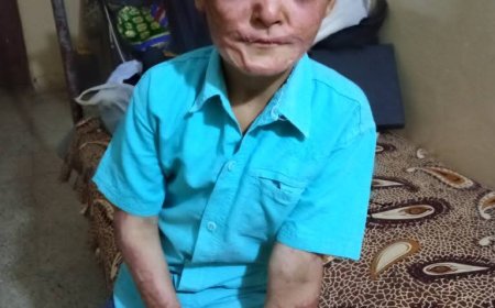 مساعدة طفل يتيم فقد والديه في حادث حريق مؤلم، ويحتاج إلى عمليات تجميل تعيد ملامح وجهه الطفولي الجميل