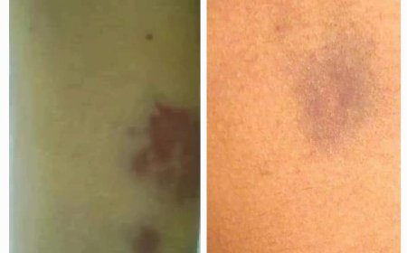 (ثقافة صحية) بعض الاناث تصاب بنزف تحت الجلد بعد الحزن او الانفعال !! 