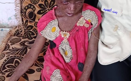 رئيسة جمعية أمواج شقرة الأستاذة أروى باسحيم تنفذ زيارة إنسانية للطفلة جميلة المصابة بمرض سرطان الجلد