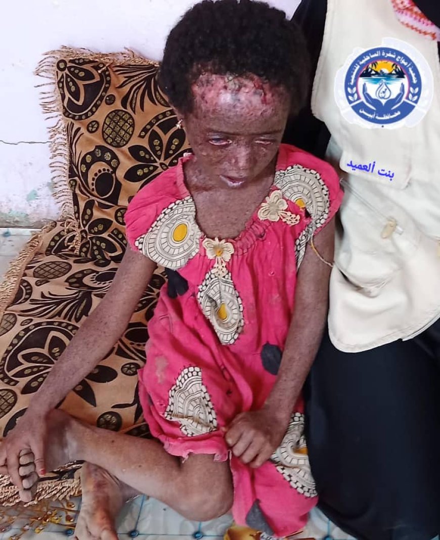 رئيسة جمعية أمواج شقرة الأستاذة أروى باسحيم تنفذ زيارة إنسانية للطفلة جميلة المصابة بمرض سرطان الجلد