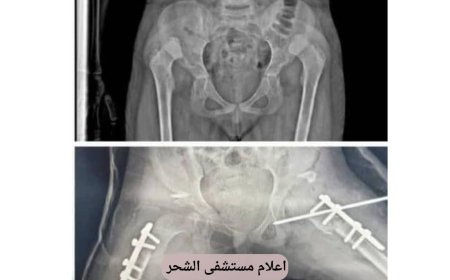 حضرموت: رغم شحة الإمكانيات نجاح عميلة نوعية بمستشفى الشحر العام