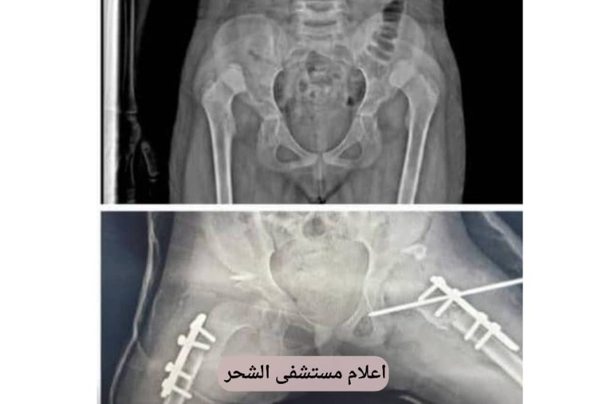 حضرموت: رغم شحة الإمكانيات نجاح عميلة نوعية بمستشفى الشحر العام