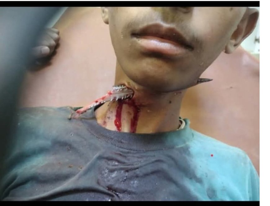 حادثة نادرة..إصابة صياد في المخا إثر اختراق "حوت الخرم" لعنقه