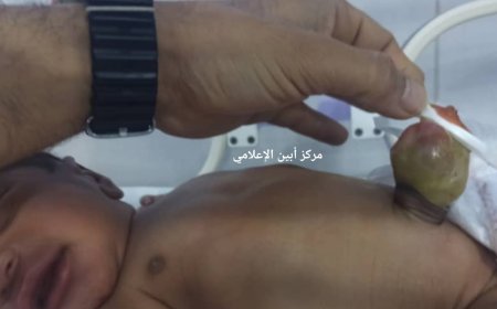 أسرته عاجزة عن علاجه.. "محمد التويم" طفل مولود من أبين خرجت أمعائه.. فهل من محسن يعالج آلامه ..؟!