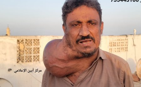 مواطن من أبين يعاني من ورم خبيث يطوق عنقه ويهدد حياته.. فمن ينقذه لوجه الله ..؟!
