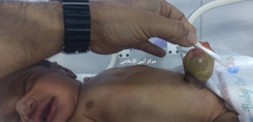 أسرته عاجزة عن علاجه.. "محمد التويم" طفل مولود من أبين خرجت أمعائه.. فهل من محسن يعالج آلامه ..؟!
