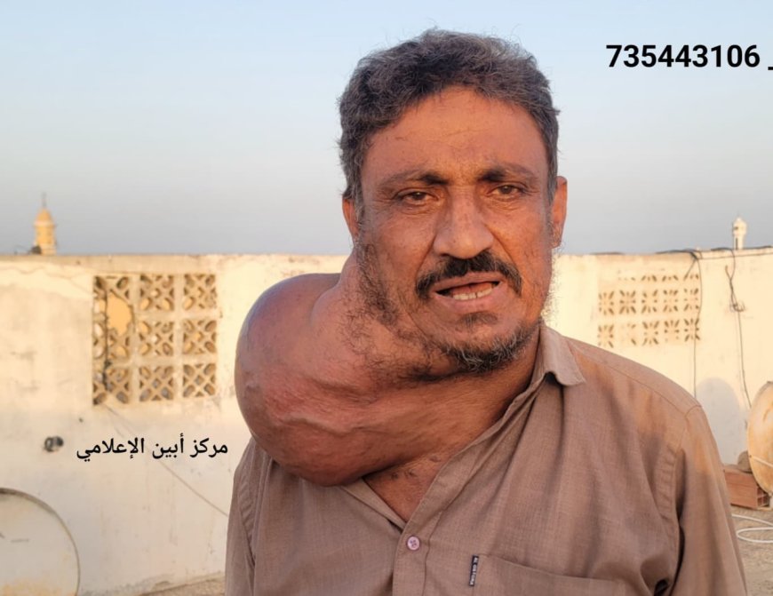 مواطن من أبين يعاني من ورم خبيث يطوق عنقه ويهدد حياته.. فمن ينقذه لوجه الله ..؟!