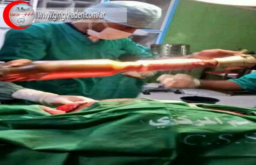 جريح بلا تقدير: قصة مقاوم يمني صُنفت إصابته ثاني أغرب إصابة في العالم… ثم تم نسيانه