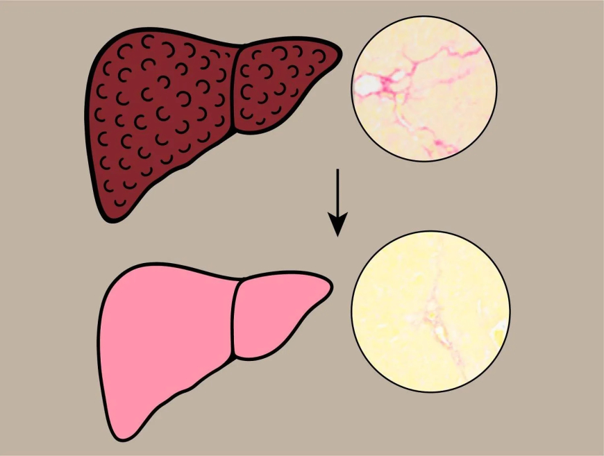 صبغة الحناء لعلاج تليّف الكبد