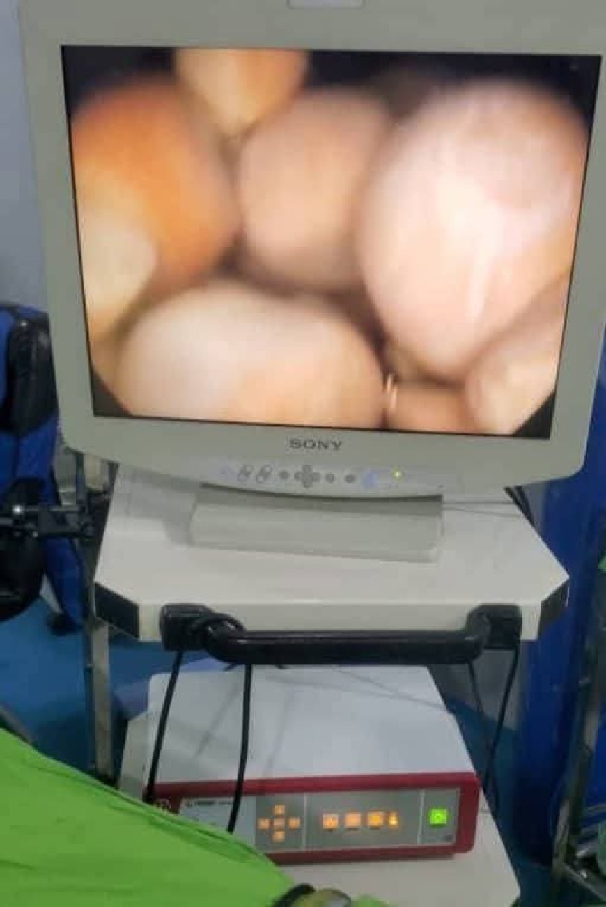 إنجاز طبي في المستشفى التخصصي الخيري عزان شبوة : استخراج 193 حصوة من مثانة مريض بالمنظار على يد الدكتور معمر الحميدي