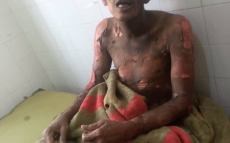 مواطن يحرق نفسه بعد خلافات زوجية في محافظة أبين 