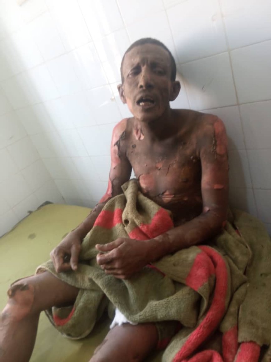 مواطن يحرق نفسه بعد خلافات زوجية في محافظة أبين 