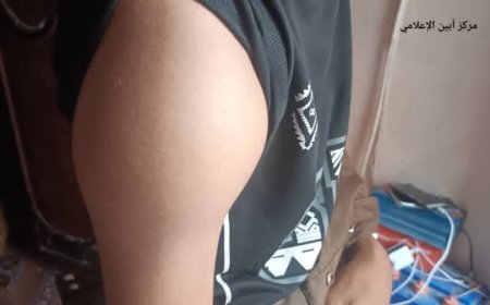 من يبادر لعلاجه لوجه الله ..؟!  *الطفل ”تيسير الكازمي” .. معاناة قاسية وآلام شديدة توجع القلب .