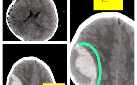 شبوة: إنجاز طبي نوعي في جراحة المخ والأعصاب بمستشفى الشهيد الدفيعة بيحان ينقذ حياة طفل