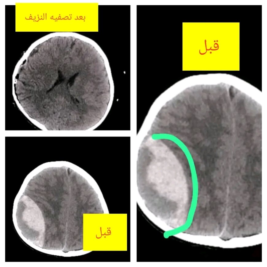 شبوة: إنجاز طبي نوعي في جراحة المخ والأعصاب بمستشفى الشهيد الدفيعة بيحان ينقذ حياة طفل
