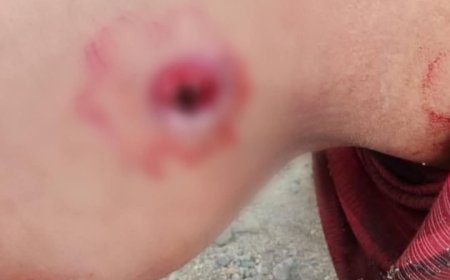 إصابة امرأة برصاص قناص حو ثــي في جبل حبشي غربي تعز.