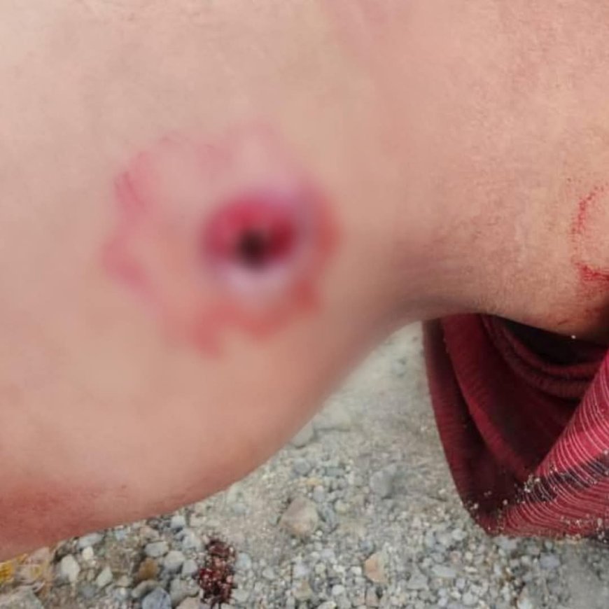 إصابة امرأة برصاص قناص حو ثــي في جبل حبشي غربي تعز.